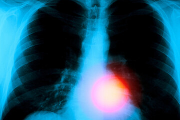 A red glow over the heart area of a chest x-ray.