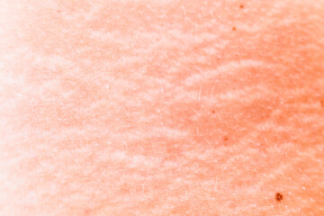 Stretch marks on the skin of a middle-aged woman, detail.