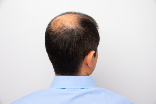 Rear view of a male head with thinning hair or alopecia with white background