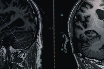 MRI of brain Dementia protocol with Alzheimer's disease  Take a picture from the computer 