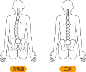 メディカル　姿勢（側弯症） 上半身　背面