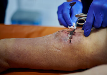 Postoperative wound dressing. The doctor examines the condition of the postoperative wound.