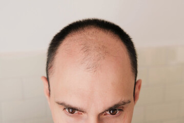 Male pattern hair loss problem concept. Young caucasian man looking at mirror worried about...