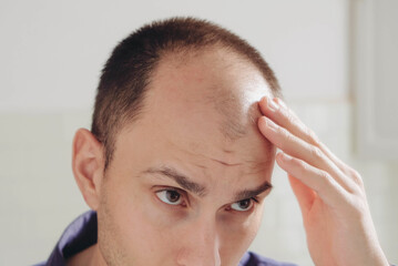 Male pattern hair loss problem concept. Young caucasian man looking at mirror worried about...