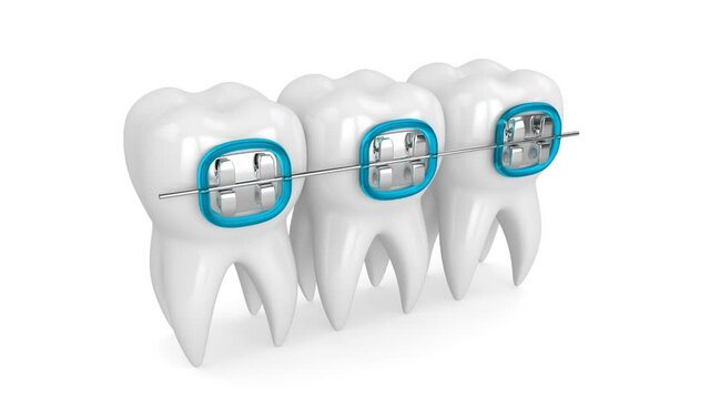 Teeth with dental orthodontic braces