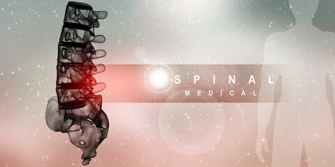 3d illustration Spinal fixation system - titanium bracket
