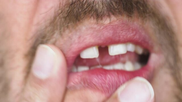 Macro of anonymous man with moustache touching face. Gap in teeth seen when he opening mouth. Concept of human body