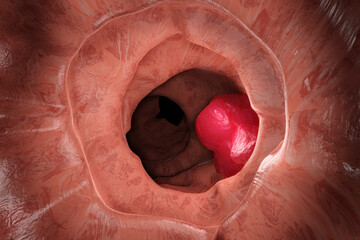 Intestinal Cancer illustration