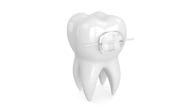 Tooth with orthodontic ceramic braces
