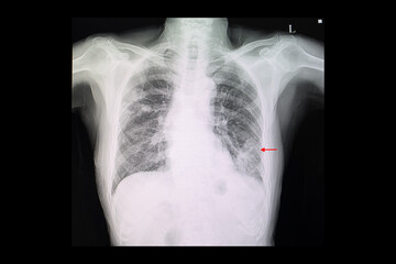 A chest x-ray film of left lower lung pneumonia