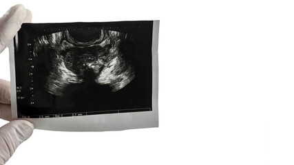 Picture of a mans prostate on an isolated white background close-up. Place for text male prostate