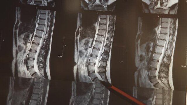 close-up image of the back on which the doctor shows the problem places x-rays and complications after covid-19