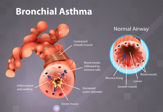 Asthma Inflamed Bronchial Tube