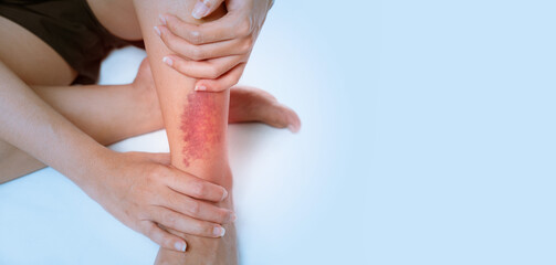 Asian women have bruise on leg from accident on clear background.