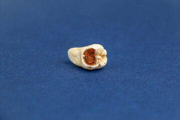 Close up of a removed sore tooth. Toothache. High quality photo