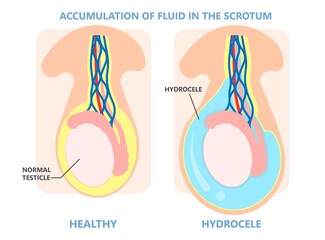Testicular Disorder men vas pus tube male pain cyst test exam self cord vein sperm Acute blood semen tract penis viral virus tumor fluid testes pelvic sexual penile trauma system prostate testis