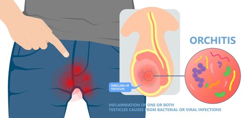 Testicular Disorder men vas pus tube male pain cyst test exam self cord vein sperm Acute blood semen tract penis viral virus tumor fluid testes pelvic sexual penile trauma system prostate testis