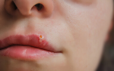 Macro photo of lips on woman's face with  herpes virus.