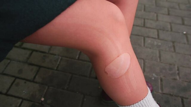 A hole in nylon pantyhose. How to prevent a run or tear in tights from spreading. Stocking material is not strong enough. Woman's leg outside, lifestyle.