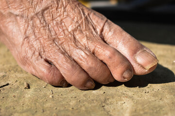 Fair toe of an old woman, her age is more than eighty .