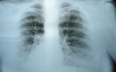 X-ray of a persons lungs with a disease, pneumonia .  Virus screening.  covid-19
