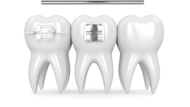 Teeth with three types of orthodontic braces
