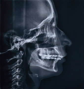 Teleroentgenographic x-ray image (TRG) of facial profile