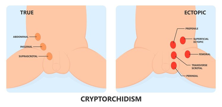 Undescended testicle cryptorchidism testicle that hasn't moved into its proper position