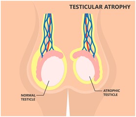 Testicular Disorder men vas pus tube male pain cyst test exam self cord vein sperm Acute blood semen tract penis viral virus tumor fluid testes pelvic sexual penile trauma system prostate testis
