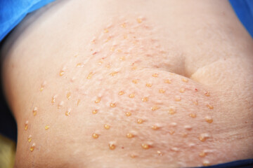 Plasmolifting. Injections for rejuvenation and skin regurgitation from human plasma. A modern beauty treatment