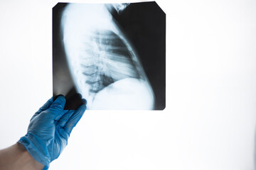 X-ray close-up side view of ribs and lungs in the hands of a doctor in blue gloves. The doctor examines the picture for pneumonia.