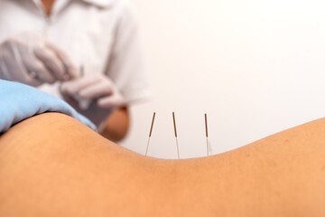 Faceless Patient Receiving Acupuncture Treatment