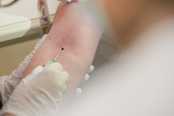 Hand of a nurse inserting a medical needle for blood extraction out of the vein on a hand of a...