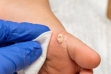 Healing treatment of cracked, dry wart, calluses on the child foot sole