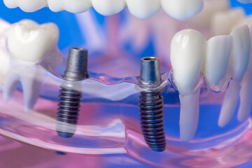 dental implant bridge screws in human jaw teeth model
