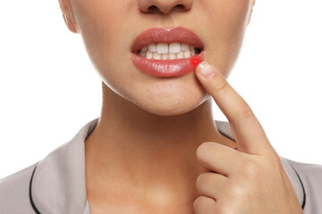 Woman with herpes touching lip on white background, closeup - obrazy, fototapety, plakaty