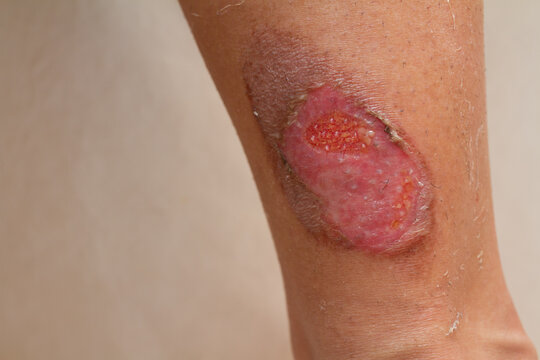 A woman suffering from a second degree muffler burn from a motorcycle