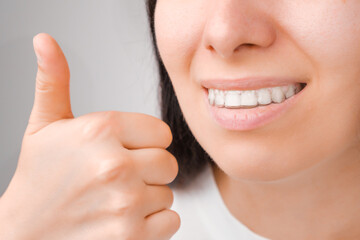 Happy woman with a perfect smile in transparent aligners on her teeth shows Like.  © vladim_ka