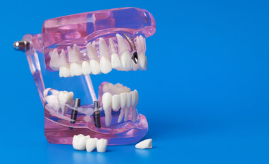 human jaw tooth model with dental implants on blue background with copy space