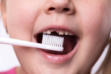 Preschool girl with first adult incisors and a toothbrush. The milk tooth has fallen out, and a permanent tooth grows in the open mouth. Dental hygiene concept