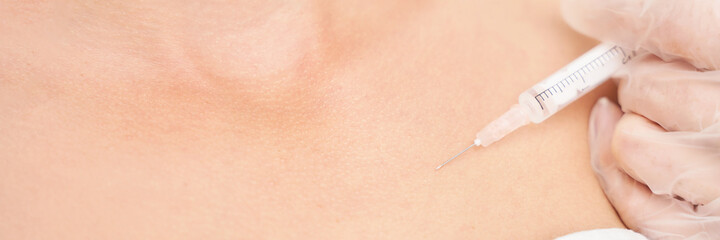 Near eye injection at spa salon. Doctor hands. Closeup. High quality. Pretty female patient. Beauty treatment. Healthy skin procedure. Young woman face. Crows feet wrinkle. Plasmolifting rejuvenation