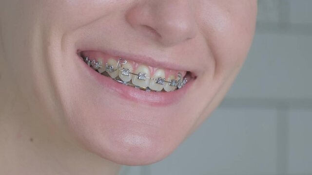 Female smile in metal braces close-up. Beautiful, happy smile of woman with self-ligating braces system on teeth. Orthodontic treatment in adults. Dental health care. Slow motion. 4k footage