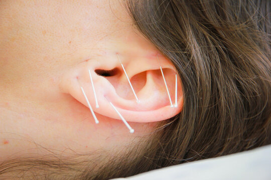 Close-up Of Woman With Acupuncture Needles On Ear