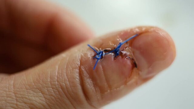 Close-up of clear liquid dripping on dry skin and stitches on the wound, on the finger. Contains people, Caucasian white, wash medical stitches, real time, natural light, medicine.