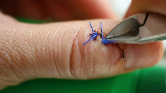 Bite through the surgical suture line. Finger wound close-up, contains people, real time, natural light, medicine.