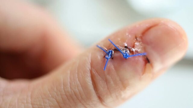 The wound and stitches on the finger are treated with antiseptic extreme close-up. Real time, contains people, trauma