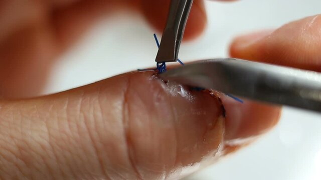 The surgical suture is pulled back and they try to bite it with wire cutters. Healed incised wound on the plz extreme close-up, real time, natural light, contains people, health care, medicine