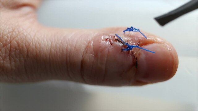 Removed surgical suture extremely close-up. Real time, natural light, contains people, health care, medicine