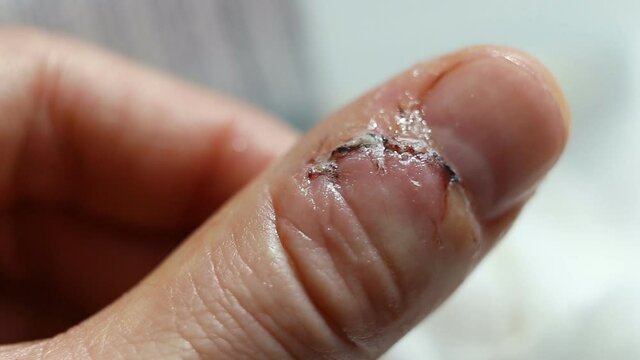 Treated with hydrogen peroxide, the wound foams. Extreme close-up, real time, natural light, contains people,