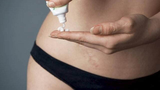 Video of girl putting cream on the appendix scar